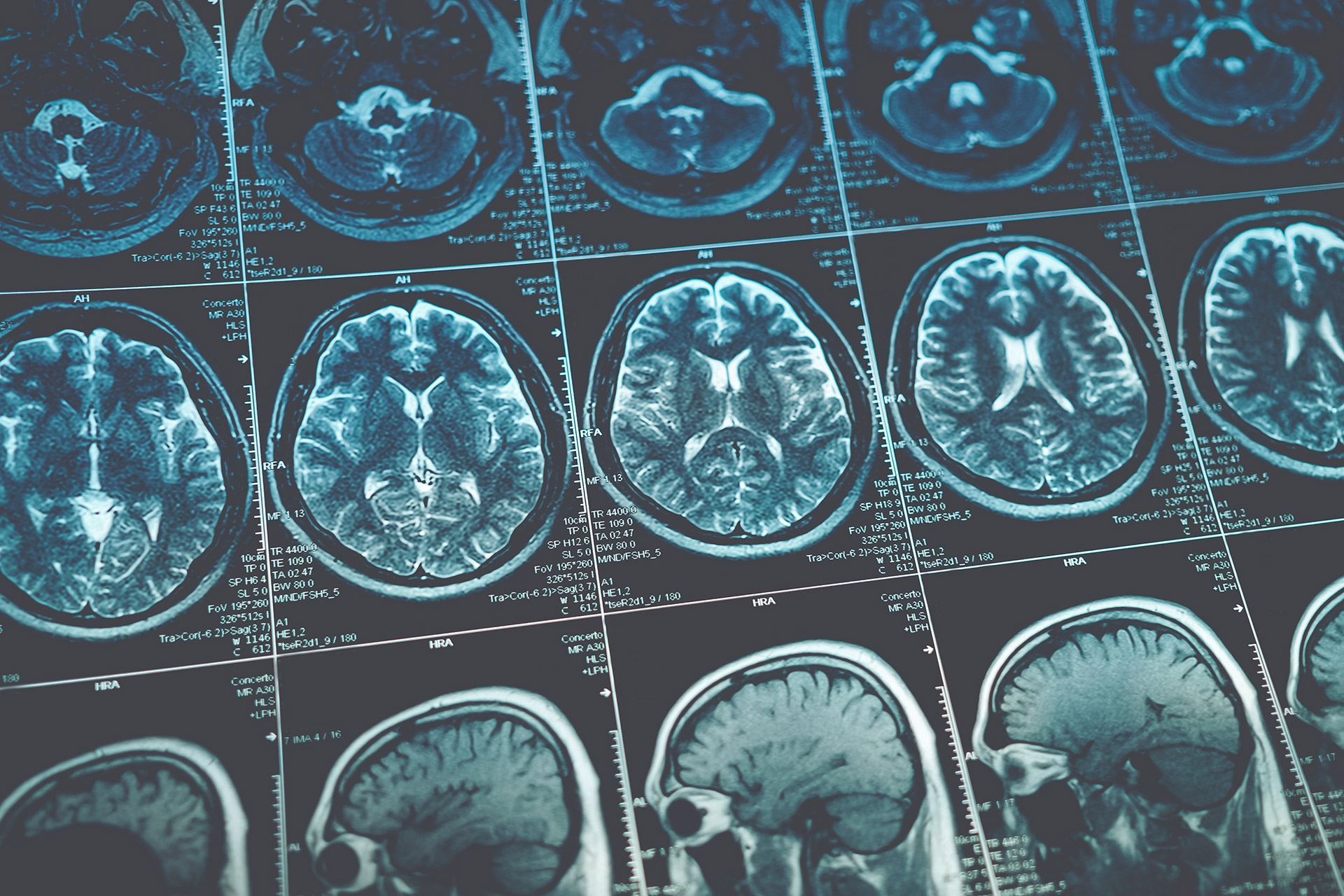 Westchester Neurological Consultants | Nerve Biopsy, EEG and VEEG and Sleep Disorders